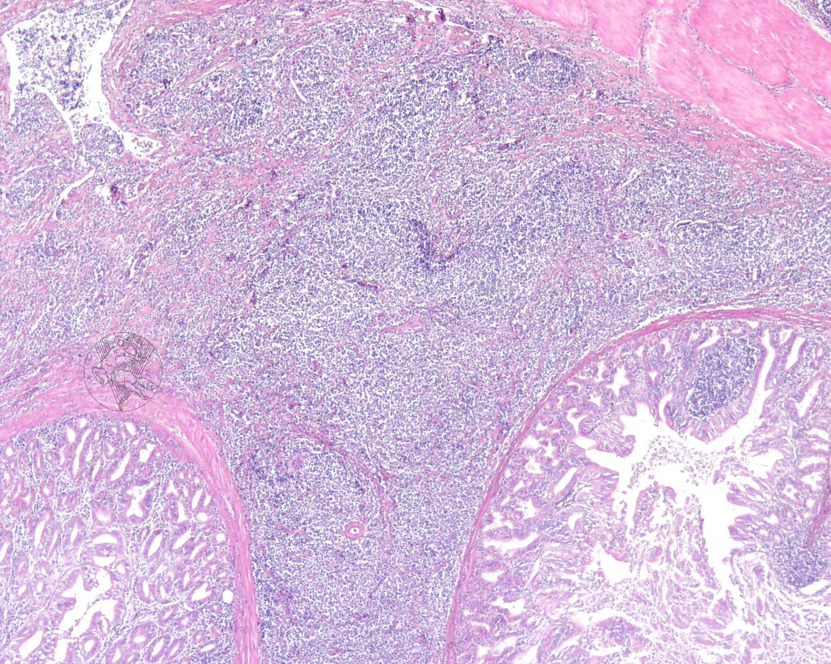 Proventriculite em Doença de Marek galinha